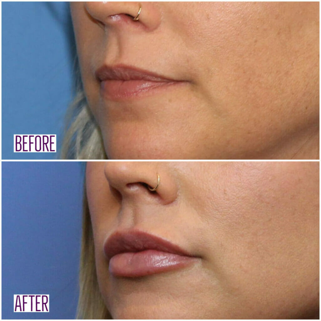 Lip Filler - Before & After side view