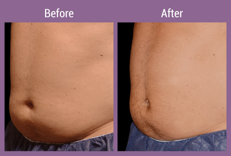 coolsculpting-beforeafter-3