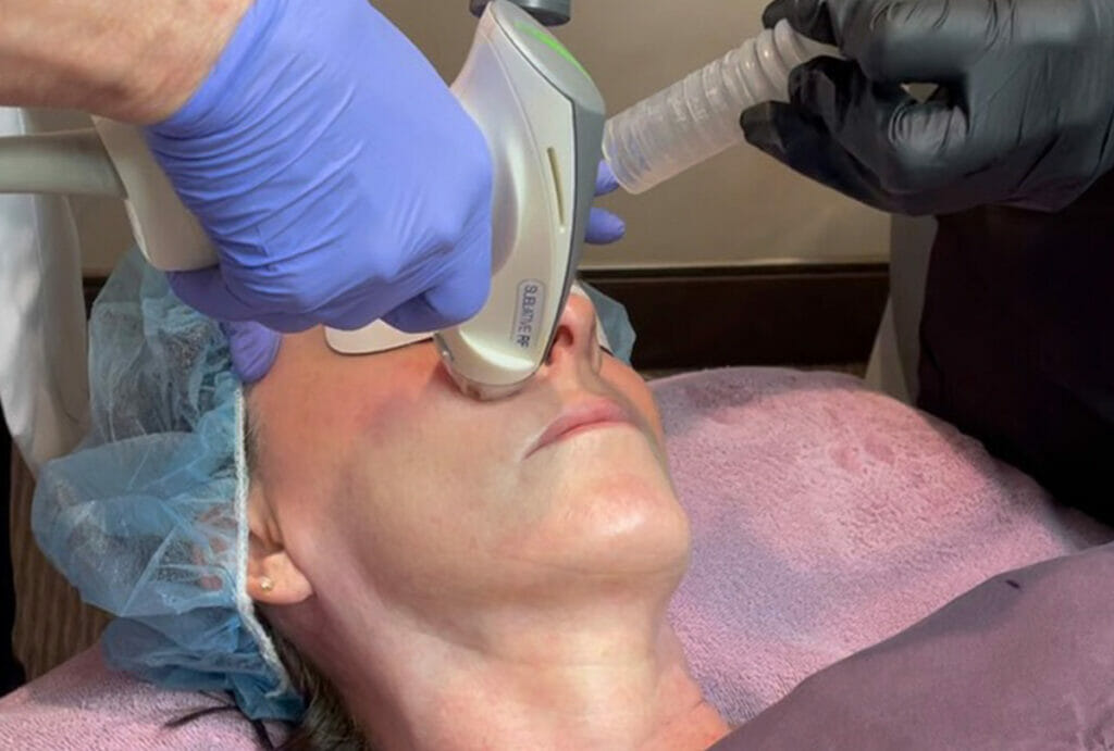 A patient receiving sublative laser treatment