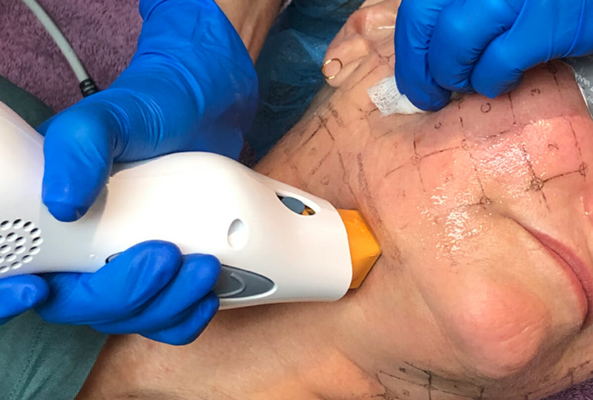 Body Skin Tightening With Thermage And Titan - Bellair Laser