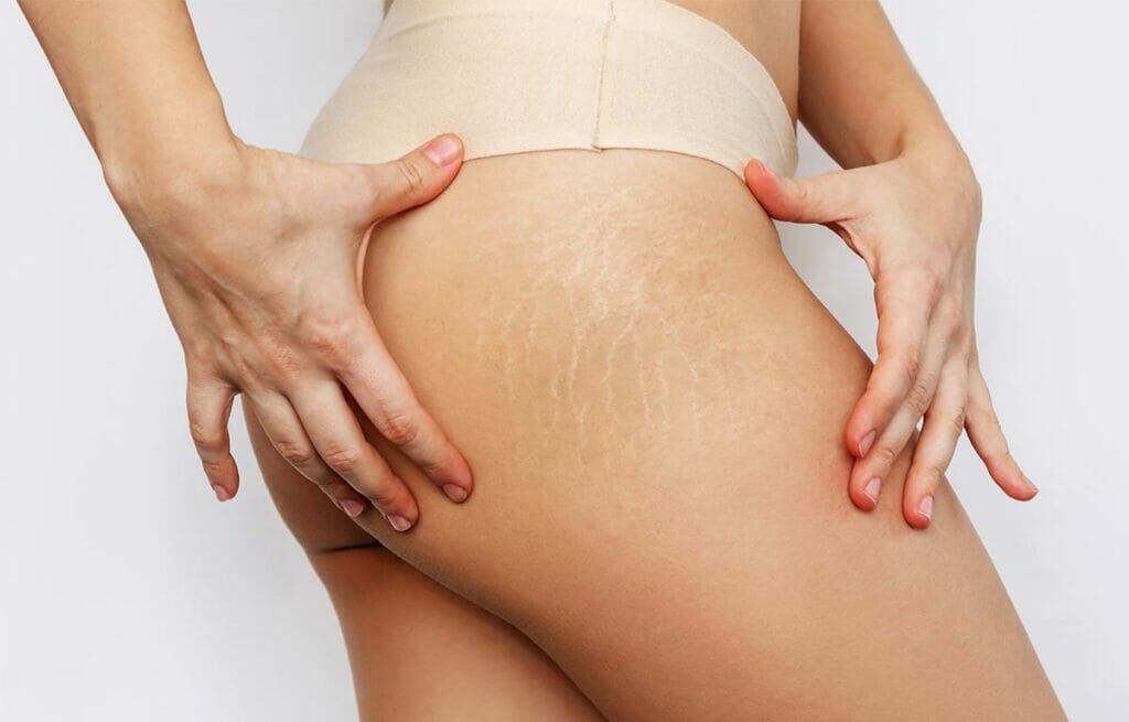 example of stretch marks