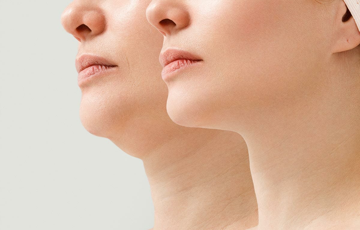 How to get rid of discount a fat neck and double chin