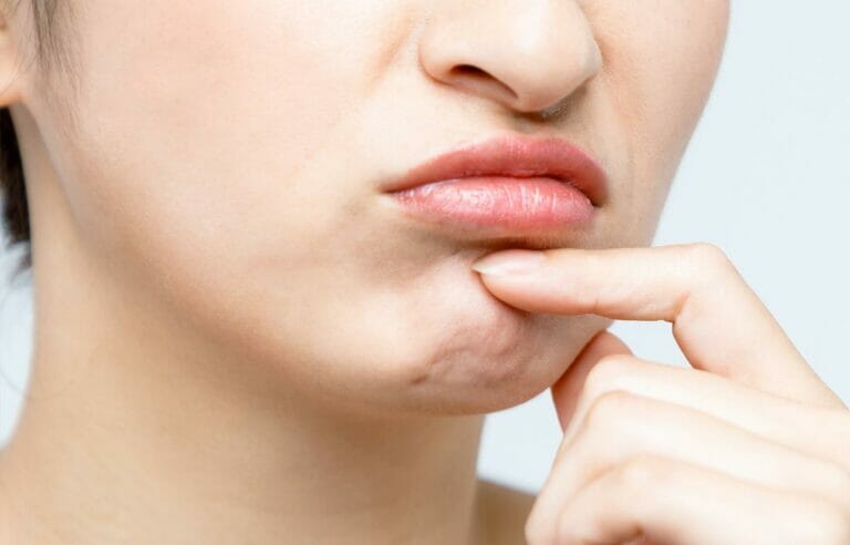 Orange Peel Chin | Allura Skin, Laser & Wellness Clinic | Fort Collins - How To Get Rid Of Orange Peel Chin Naturally