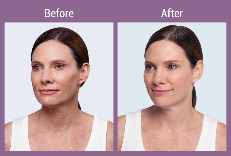 allura-before-after-restylane-3