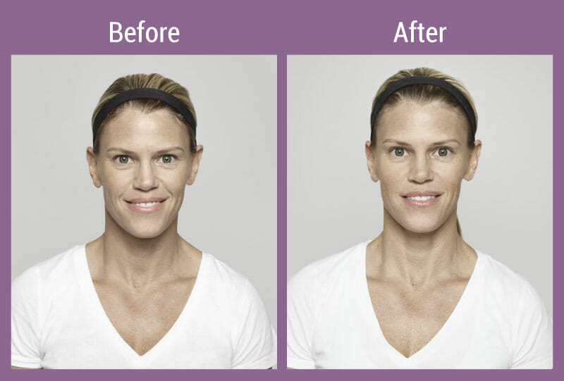 allura-before-after-restylane-4