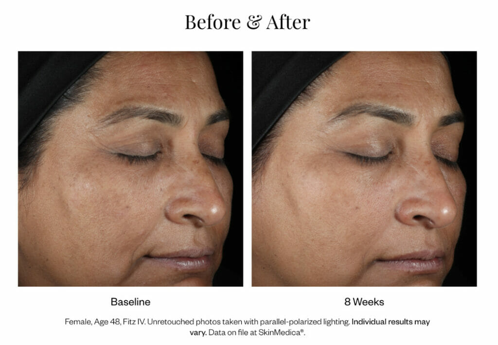 Lumivive System from SkinMedica before and after photos after 8 weeks of treatments.
