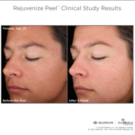 PEEL PACK FOR SKIN PERFECTION