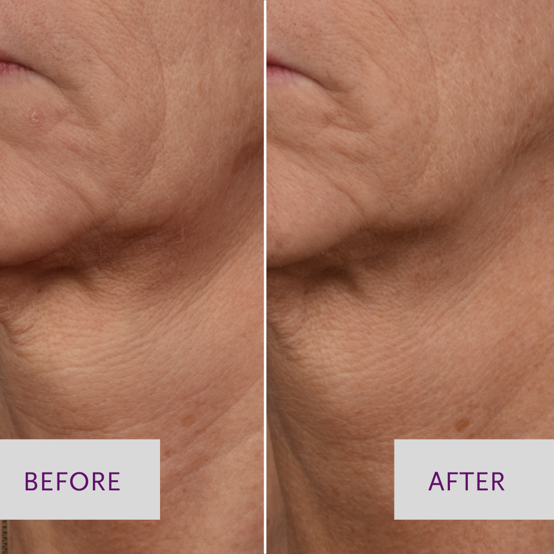 before and after photo of microneedling neck treatment