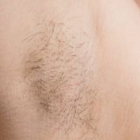 LASER-HAIR-REMOVAL-THUMBNAIL