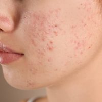 acne-treatment-fort-collins-allura