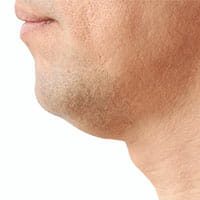 allura-kybella-men-thumbnail